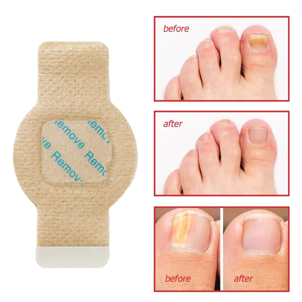 OZUAZ Hydrogel Anti Fungal Nail Correction Stickers